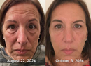 BotoxLux Restauração Facial