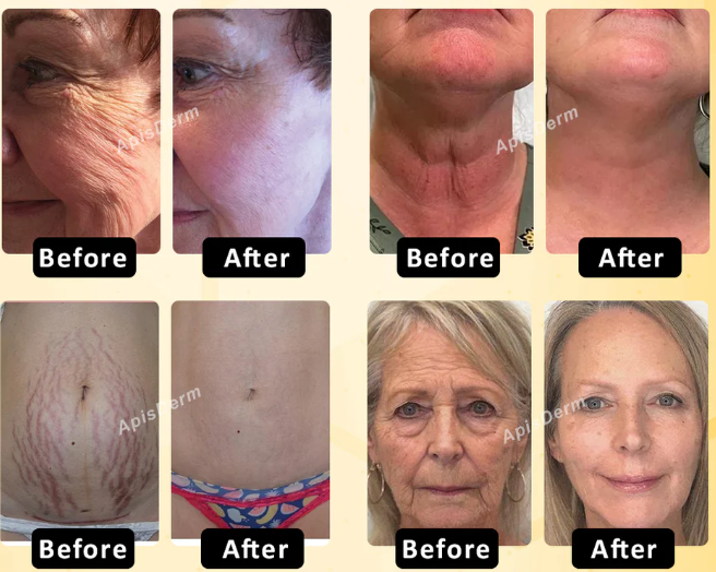 ApisDerm™ BotoxBee