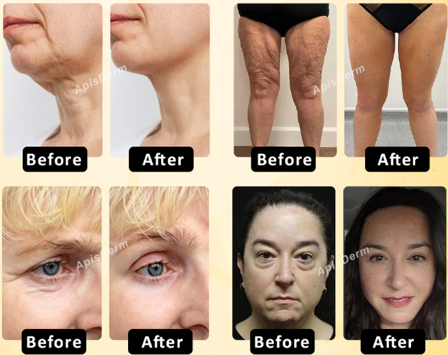 ApisDerm™ BotoxBee