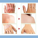 Creme para psoríase com veneno de abelha Dobshow™